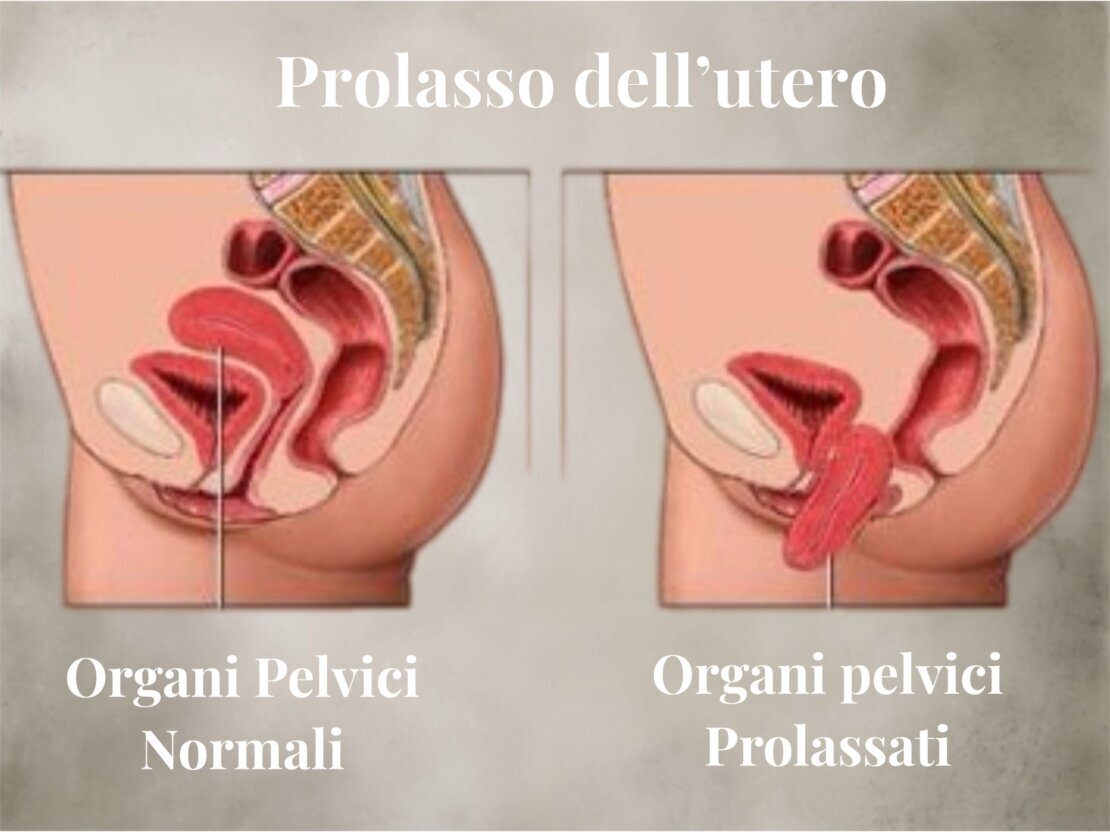 prolaasso uterino